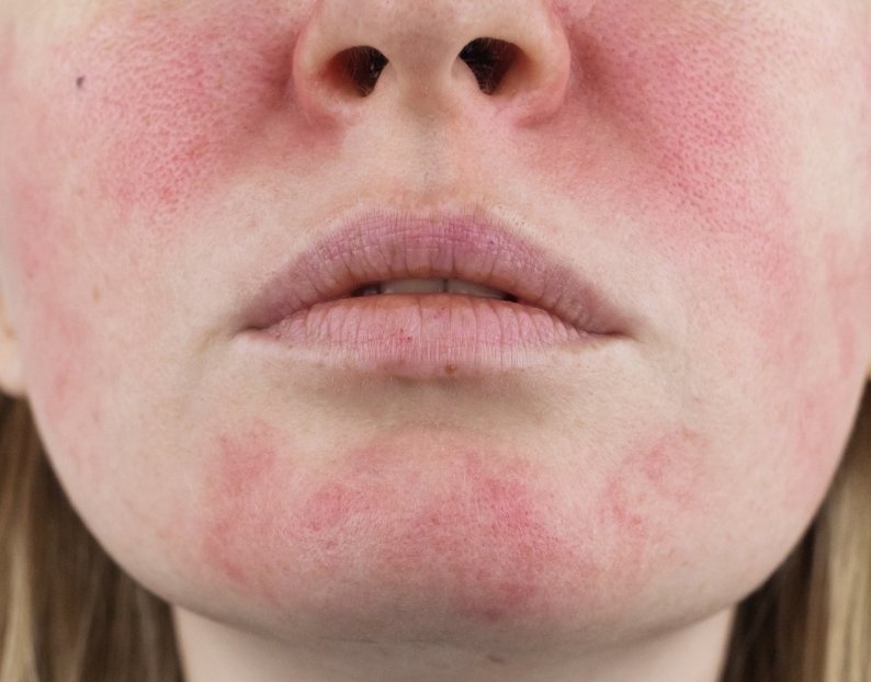 Rosecea Skin Treatments at JBH Aesthetics Camden NSW