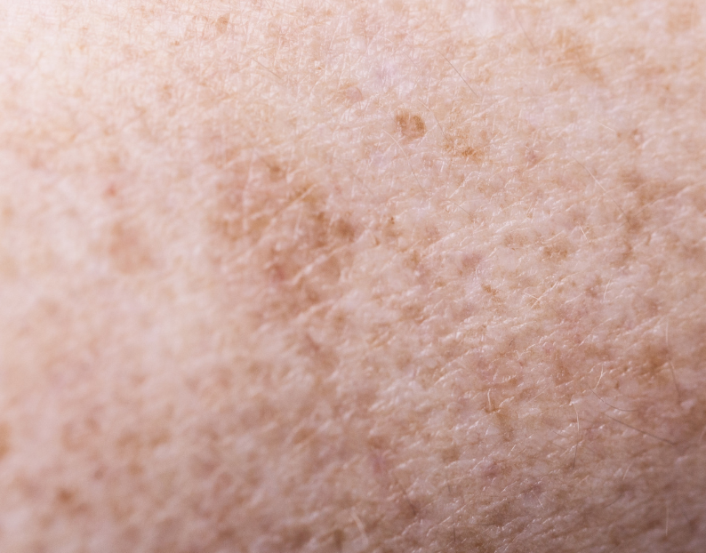 Pigmentation and Melasma Skin Treatments at JBH Aesthetics Camden NSW