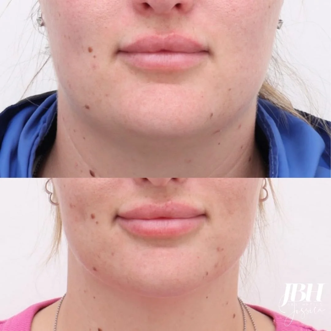 Morpheus8 Before and After Treatments - Results by JBH Aesthetics Camden