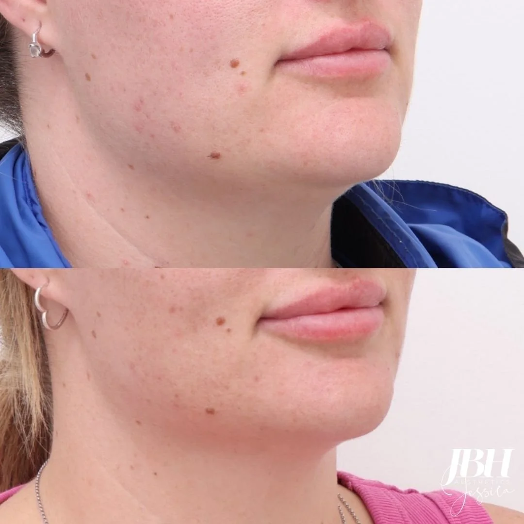 Morpheus8 Before and After Treatments - Results by JBH Aesthetics Camden
