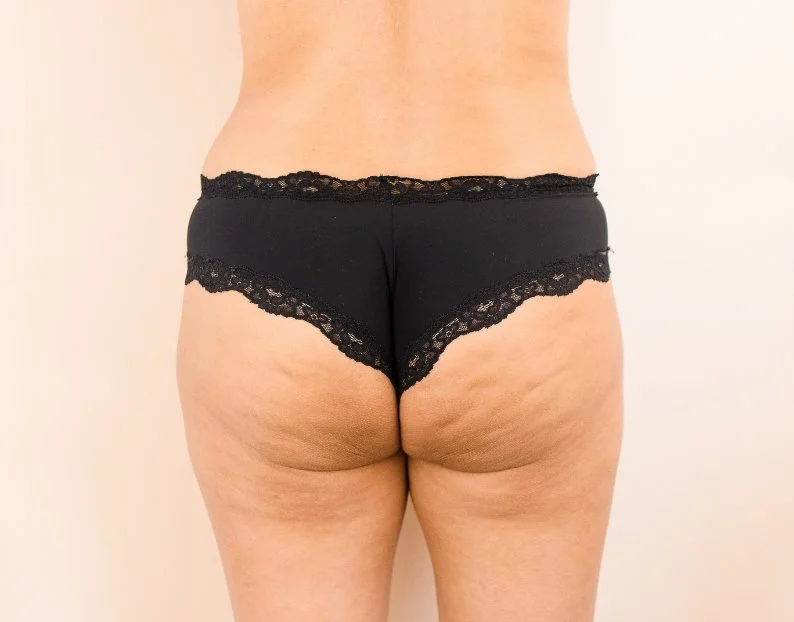 Cellulite Treatments - JBH Aesthetics Camden NSW