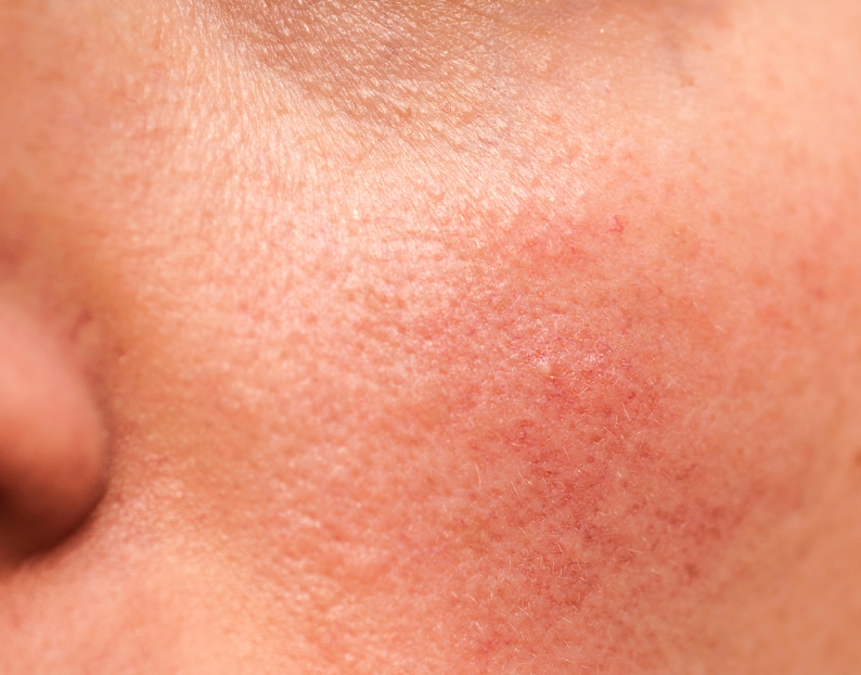 Sensitive Skin Treatments at JBH Aesthetics Camden NSW