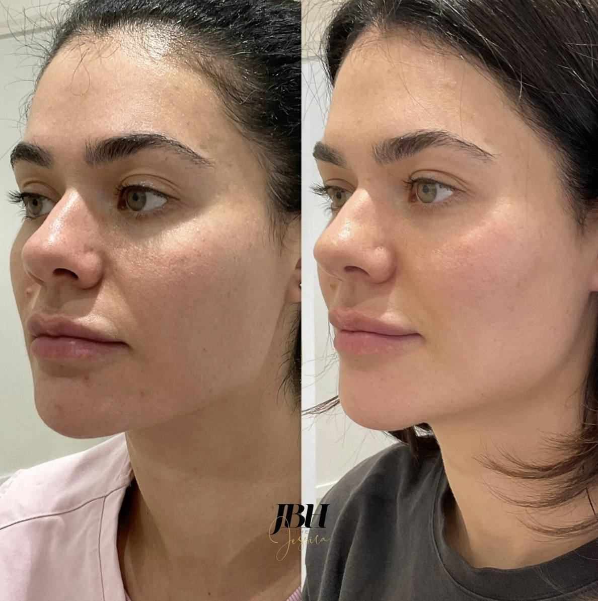 Before and After HydraFacial Treatment - Results by JBH Aesthetics Camden