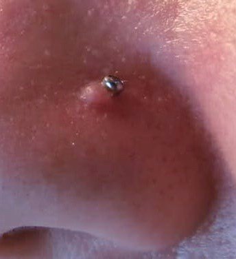 Second hole piercing. Keloid, bump, infection? : r/piercinghelp