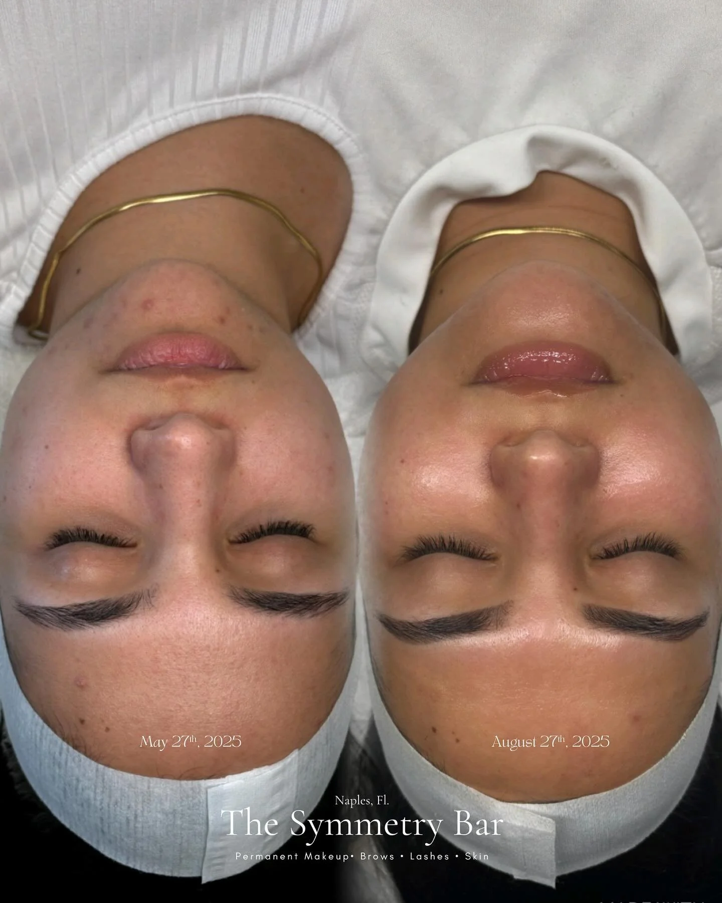 ✨ Let me Clear your Acne, and your Hyperpigmentation.✨

3 months of dedication to the skin, and look at that glow! We still have some more to get to on the other side and lower chin, but we&rsquo;re getting there! That&rsquo;s taking home her recomme