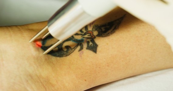 How Does Tattoo Removal Work? | Getting Laser Tattoo Removal | Dallas Tattoo  Removal — Eden Body Art Studios