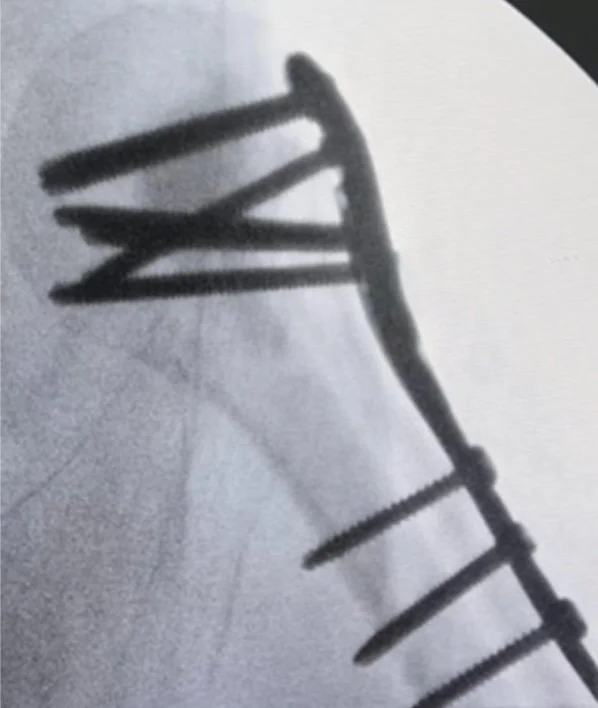 Osteosynthesis of 3- or 4-part proximal humeral fractures in older adults using locking plate with or without synthetic bone graft augmentation: a randomized clinical trial
