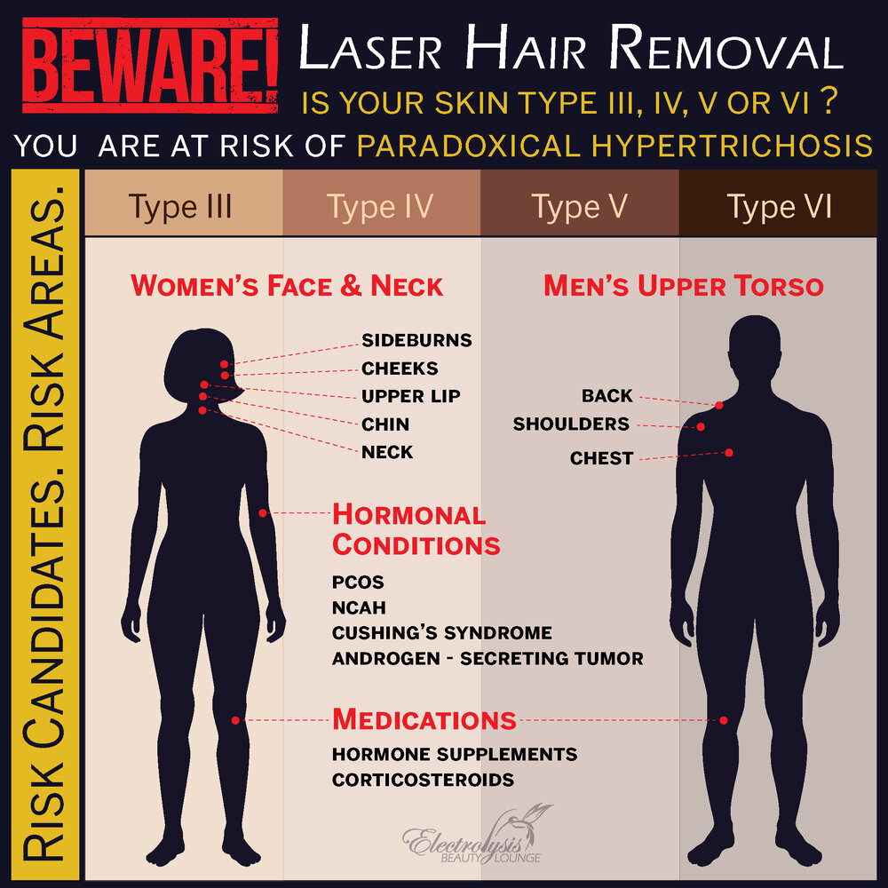 Paradoxical Hypertrichosis — Beware of Laser Hair Removal
