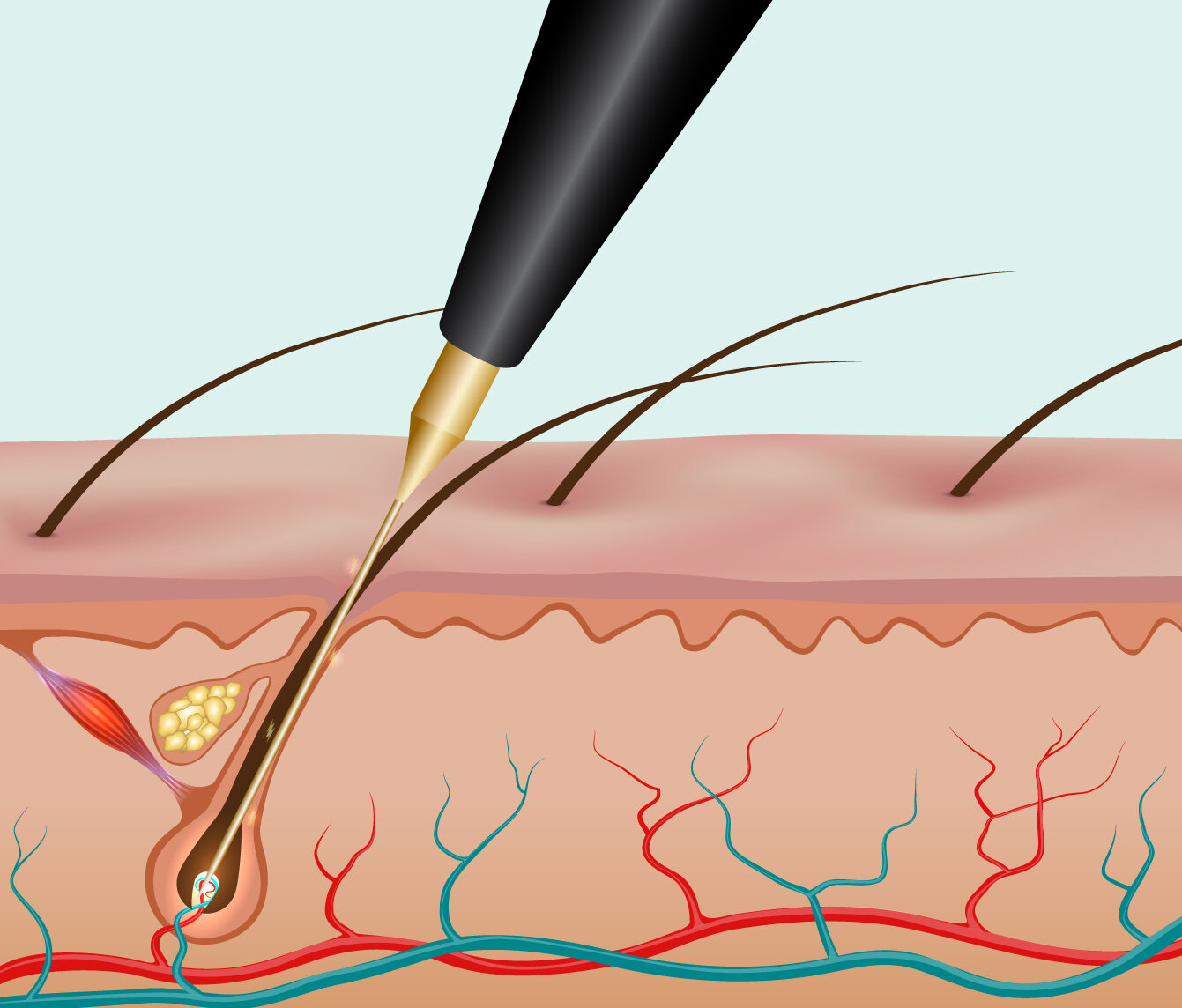 Is laser hair removal permanent Get the facts here