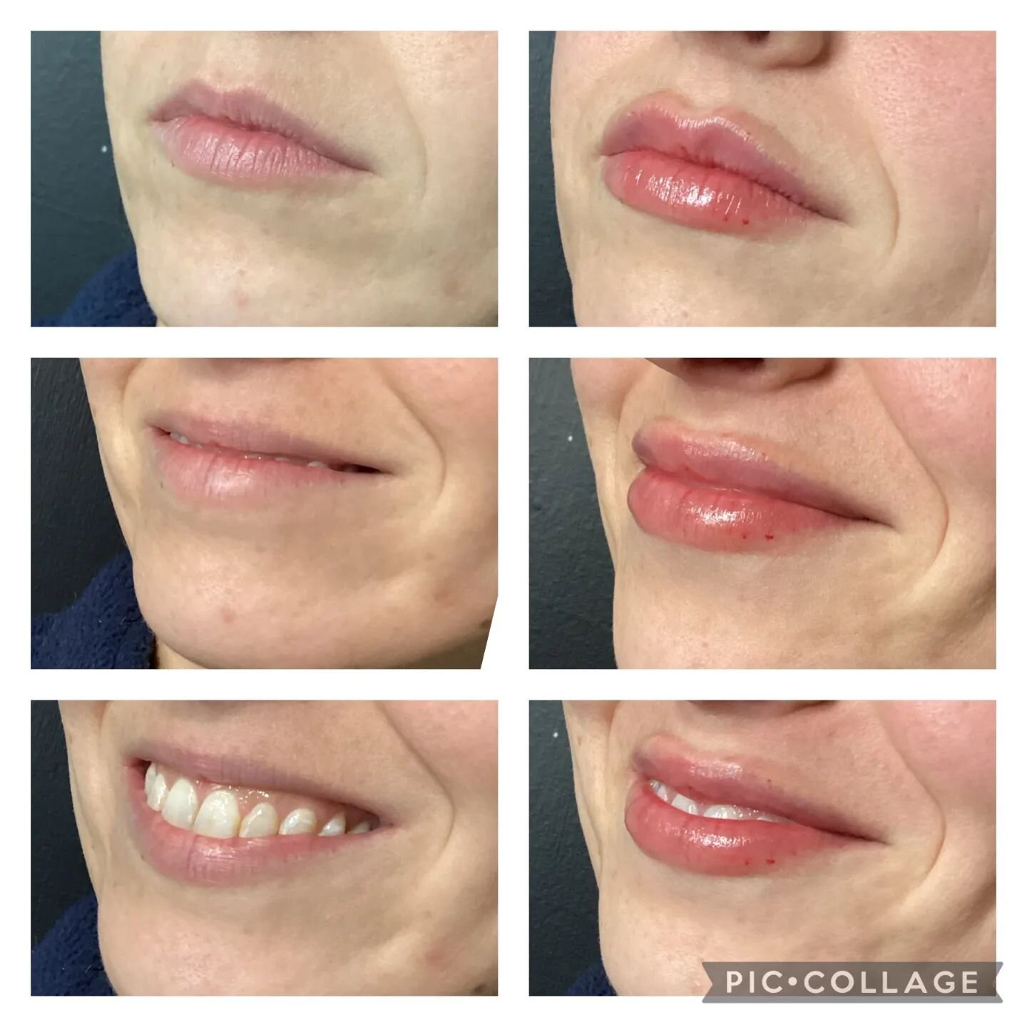 This beauty got 1 syringe of  filler for natural looking fuller lips.  Check out @injector_tine for more!
