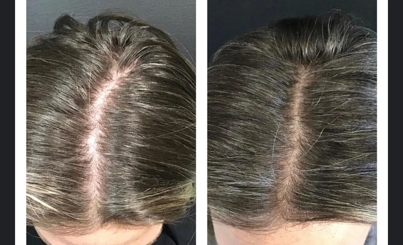 Hair loss? Thinning hair? 
Series of 3 Hair Loss treatments for $1500.  Platelet Rich Plasma (PRP) non-surgical hair restoration uses your body's own blood product to stimulate new hair growth and improve the health and texture of existing hair. 
Tre