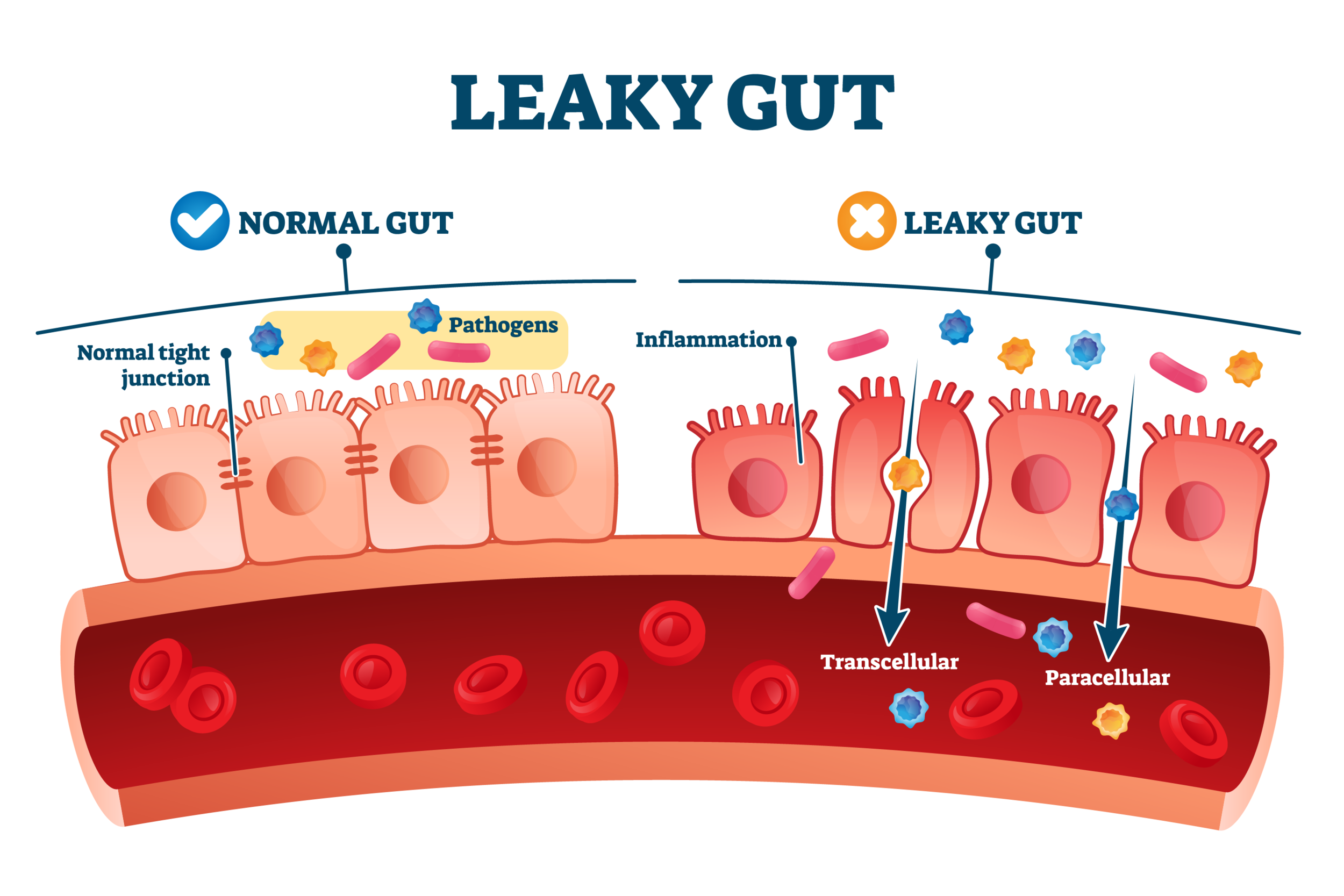 Weight Gain Ca By A Leaky Gut