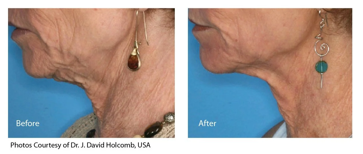 EcoTone | eCO2 Laser before and after photo