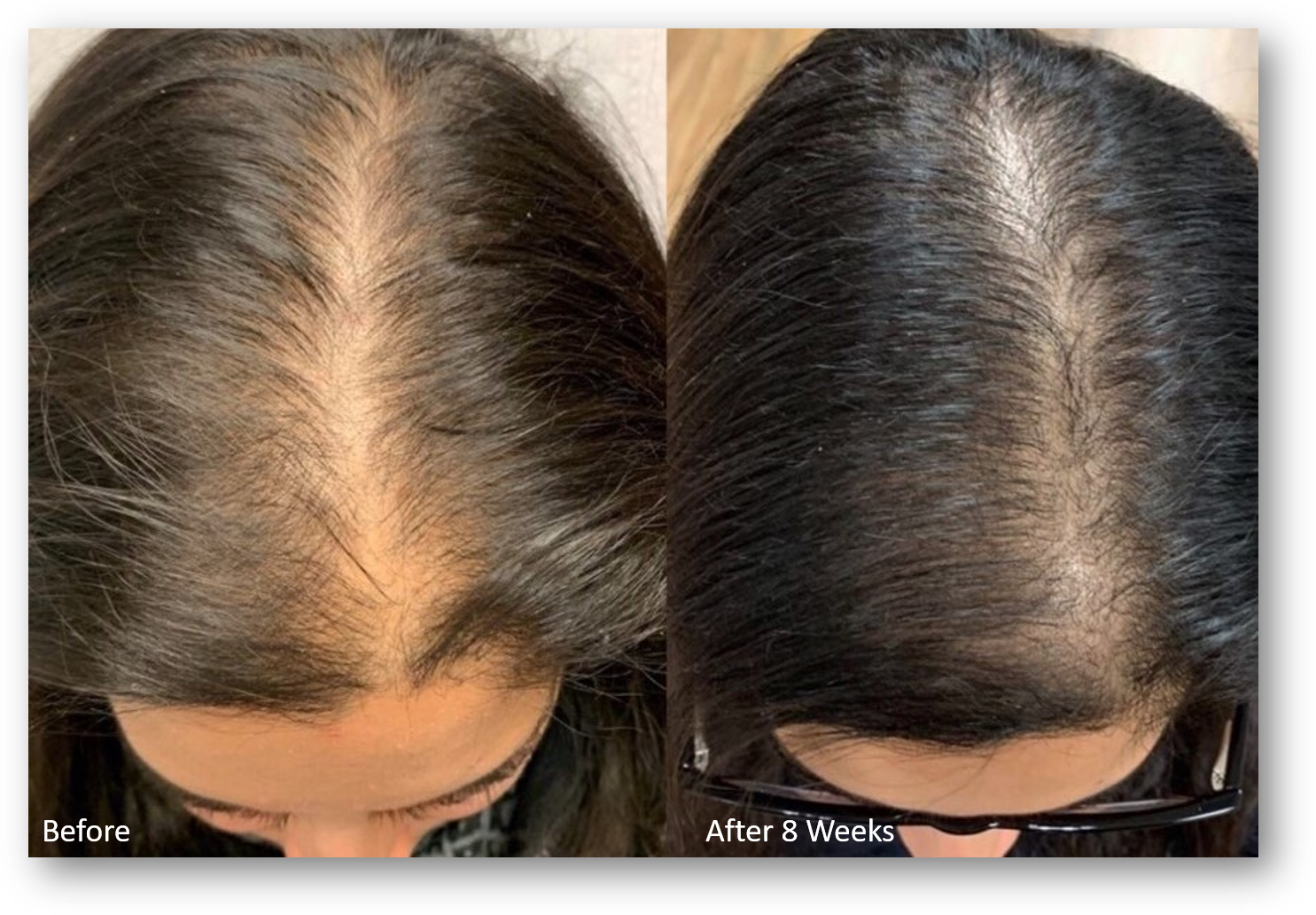 What is KERALASE and Why is It Better than PRP? Best Hair Loss Treatment:  Kerafactor — Rejuve Medspa | Emsculpt NEO | Laser Hair Removal | Anti-Aging  Treatments | Botox | EMSELLA |