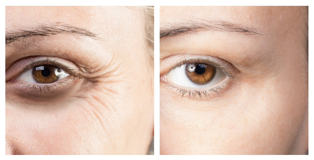 Botox & Dysport | Rejuve Medspa