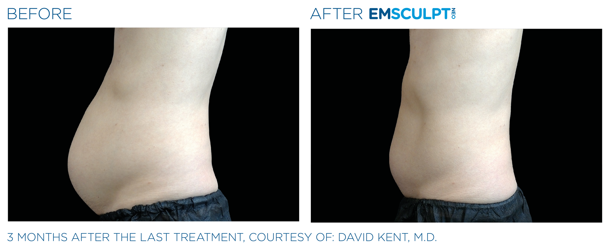 More muscles, less fat! New EMSculpt NEO with radiofrequency