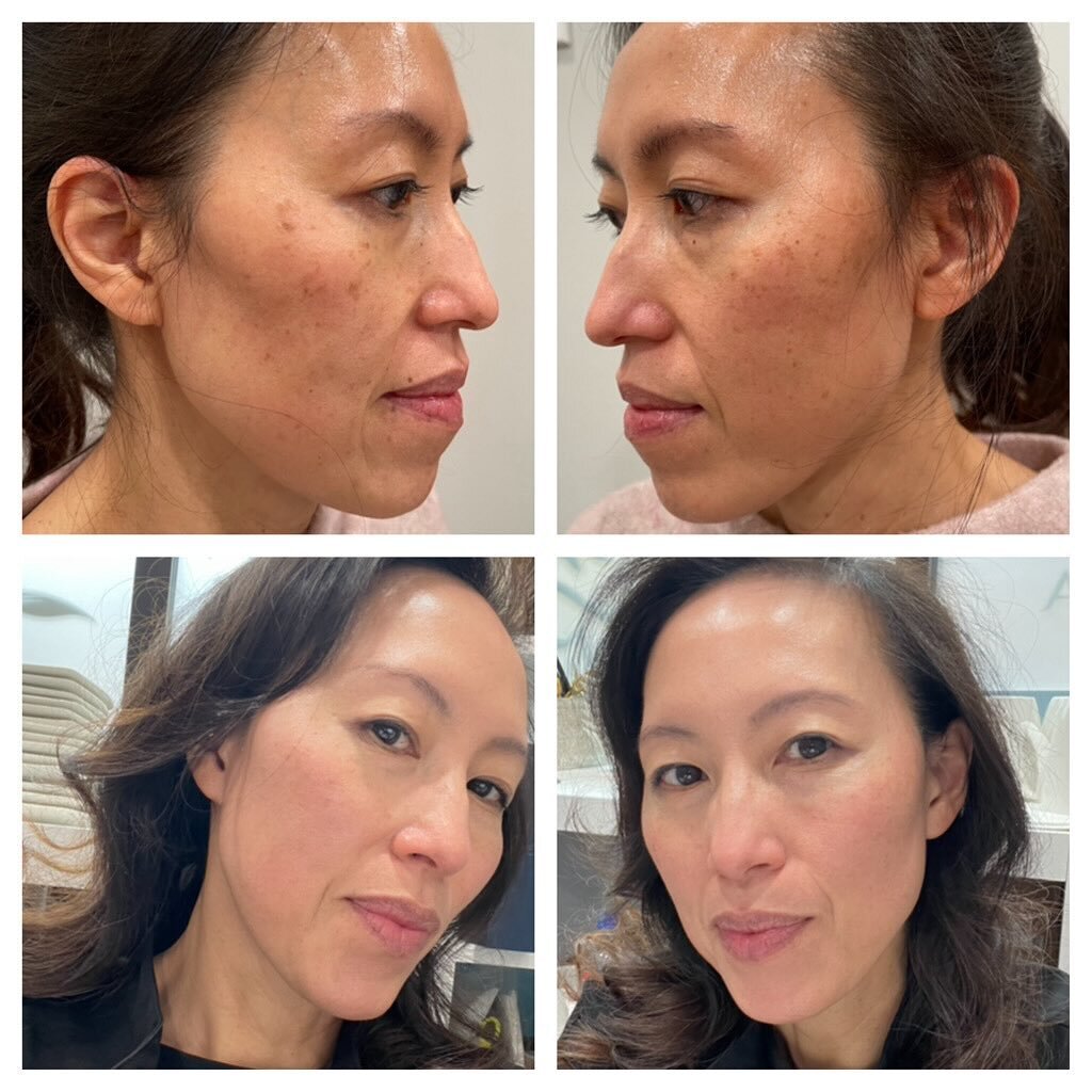 As we wrap up the last day of 2023, I wanted share my skincare journey over the last couple of years. If there was one thing that I could tell my younger self about skincare, it would be to do a better job about protecting my skin from sun damage! I 