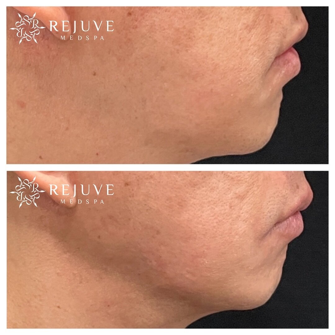 Want a more defined jawline? Knowing how to achieve this relies on your provider offering the best option for you depending on your unique anatomy and goals. At Rejuve Medspa, we offer a personalized and boutique experience. Book a consult to learn m