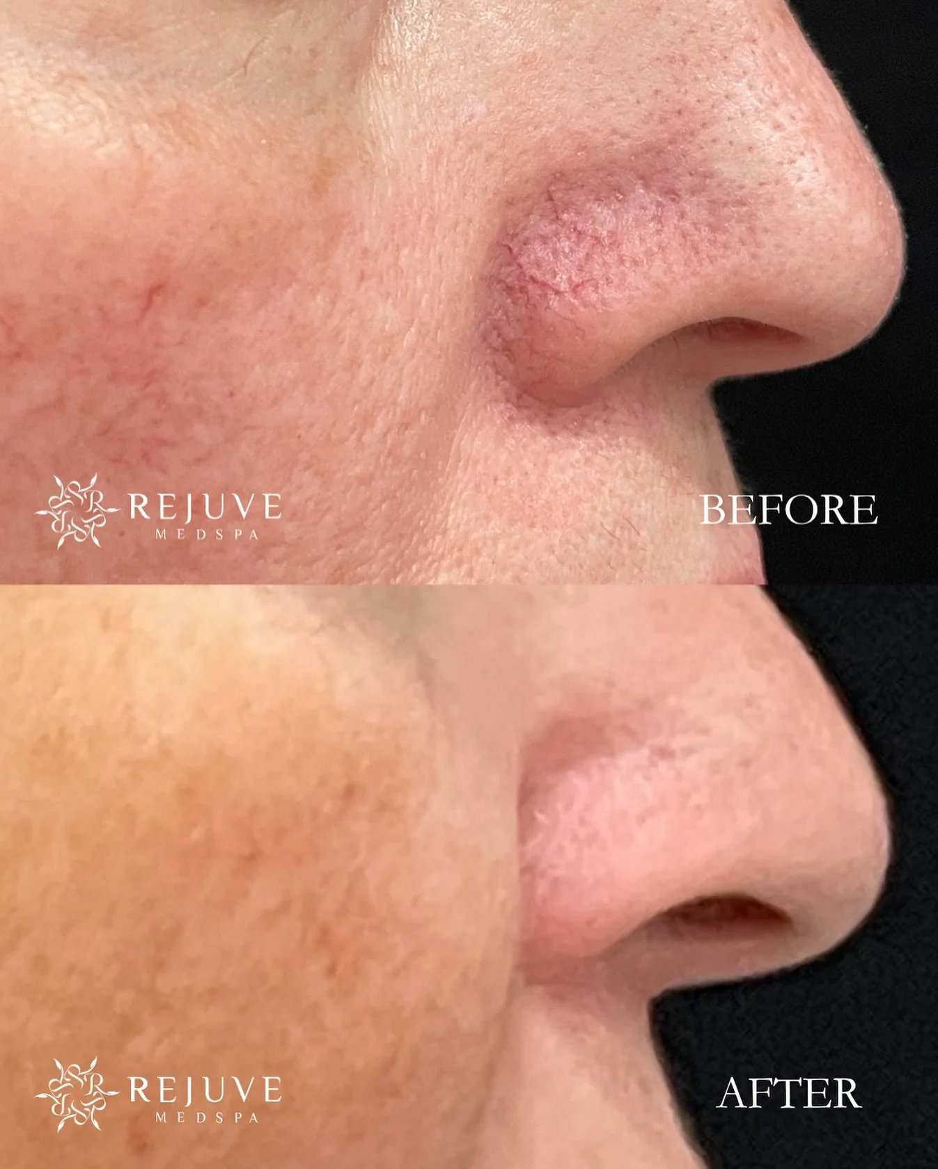 Broken Capillary Treatment &ndash; after 1 session with Clarity II Laser
Notice visible improvement in redness and tiny vessels after just one treatment. The targeted energy gently collapses superficial blood vessels without damaging the surrounding 