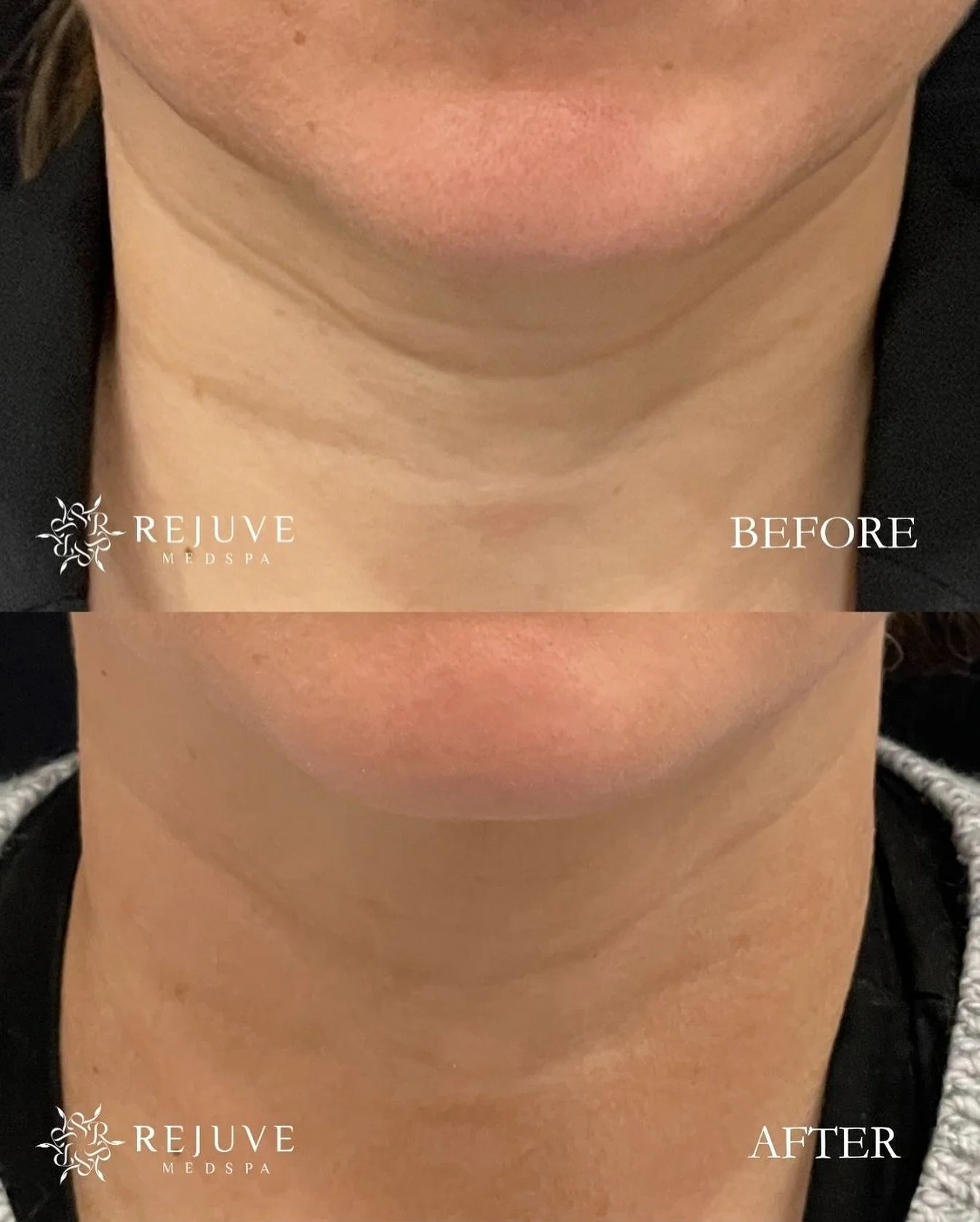 Smooth, Refine, and Restore ✨
Neck lines&mdash;often called &ldquo;tech lines&rdquo;&mdash;are one of the earliest signs of aging and collagen loss. RHA Redensity is a dynamic, lightweight filler designed to smooth fine lines while improving skin qua