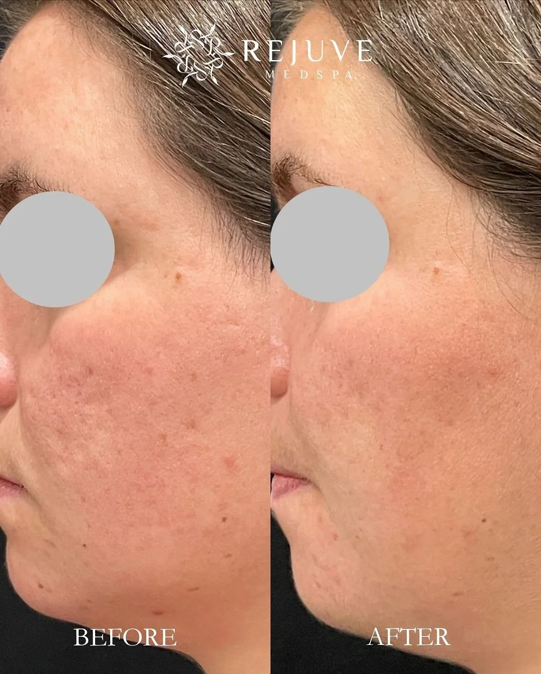Stubborn acne scars don&rsquo;t have to be permanent. Our powerhouse combination of Genius RF Microneedling and LaseMD Ultra Laser remodels collagen from deep within&mdash;refining texture, fading scars, and restoring your skin&rsquo;s natural glow. 