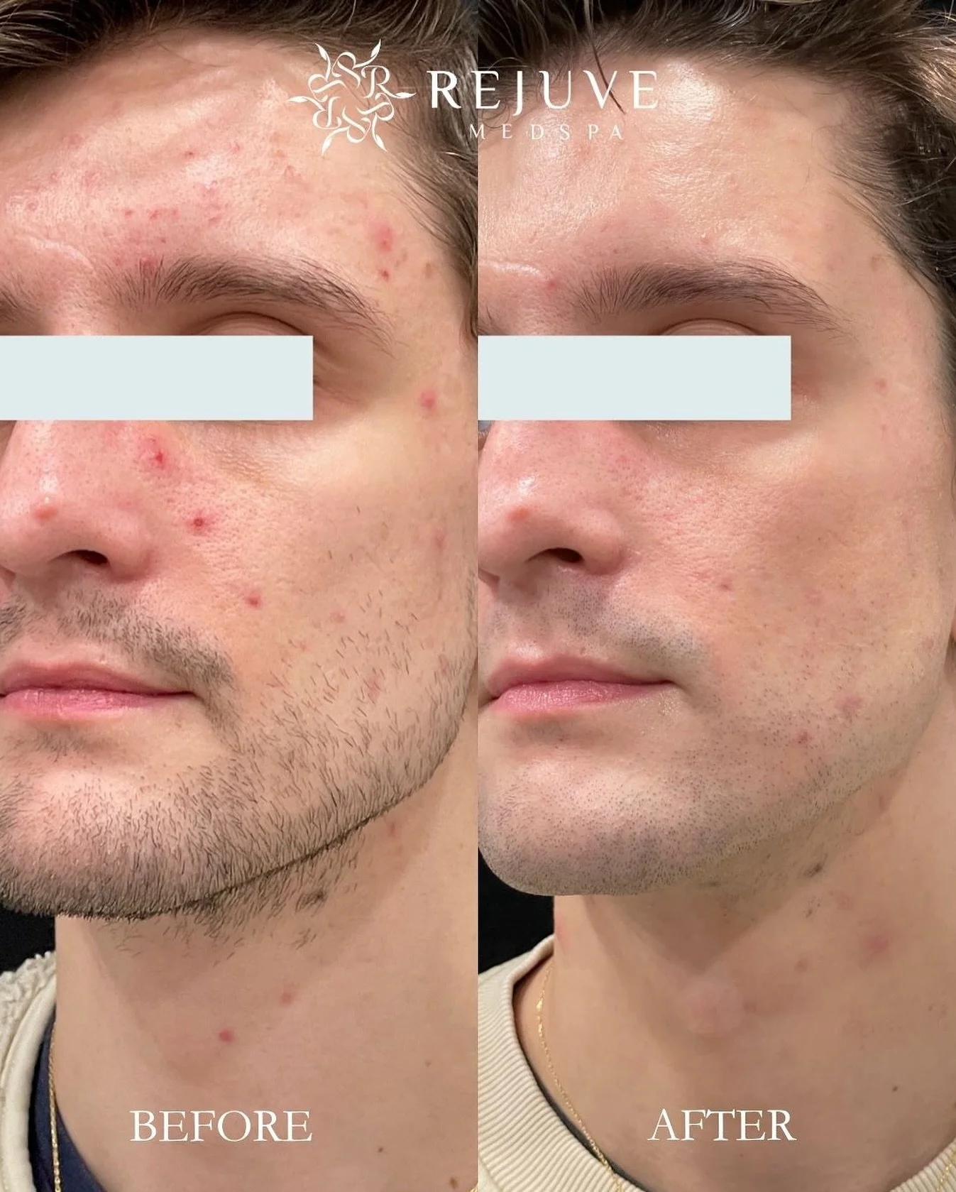 1 month after medical grade skincare and immediately after our signature Hydro Dermabrasion Facial - improved skin barrier and reduced acne outbreaks. Every skincare journey is unique, and we are honored to be a part of that journey. 

Link in the bi