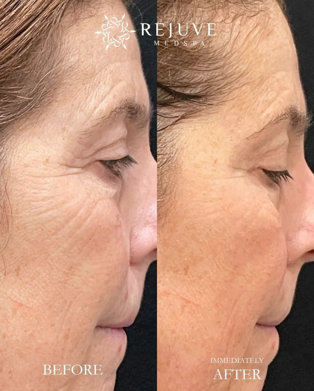 XERF builds collagen while targeting the retaining ligaments and SMAS layer of the face/neck to promote structural skin tightening. With no downtime, it&rsquo;s becoming our most popular rejuvenating treatments. These photos (shared with the permissi