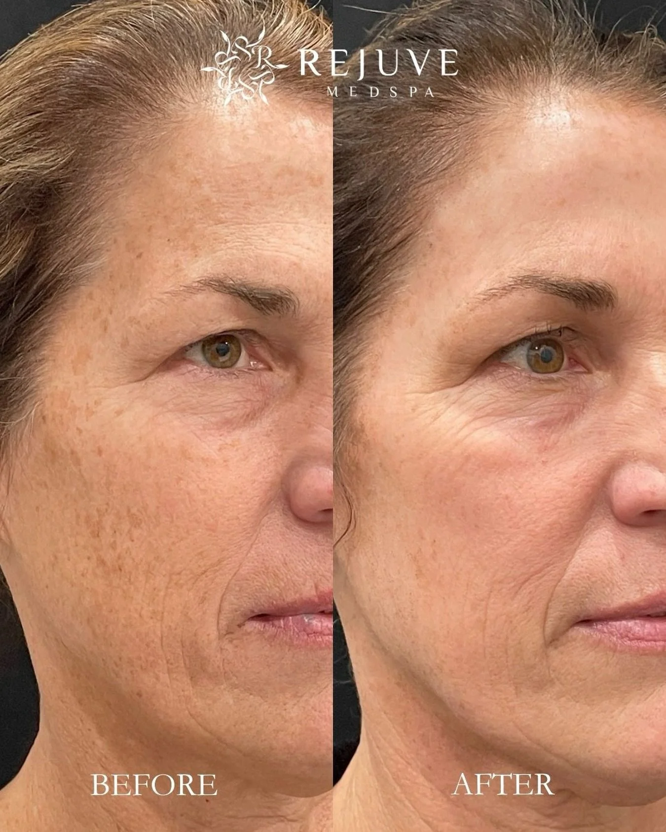 1 session of Clarity Ultra Glow reduces sun damage, improves skin texture, &amp; promotes collagen stimulation for a more radiant complexion. Link in the bio to book a consult. 

Photos are shared with the permission of our patients. Individual resul
