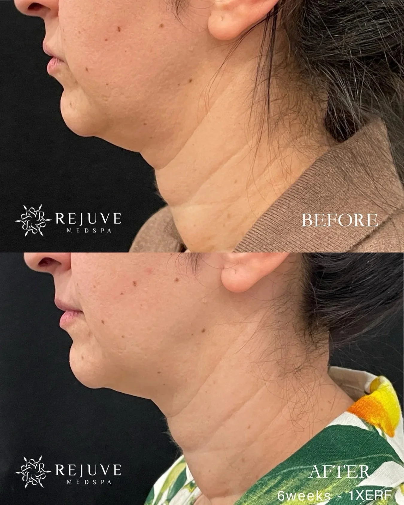 6 weeks after 1 session of XERF structural skin tightening already reveals improved skin laxity.  Collagen stimulation should continue for 6-12 months and further improvements are expected. 

XERF uses 2 different frequencies to target the surface, m