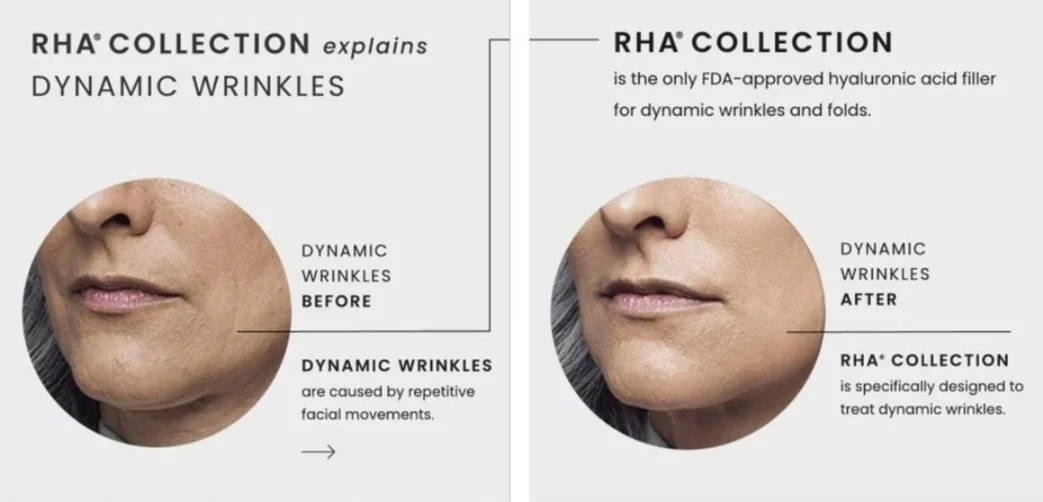 RHA Filler — Rejuve Medspa Newcastle near Seattle, Bellevue, Renton