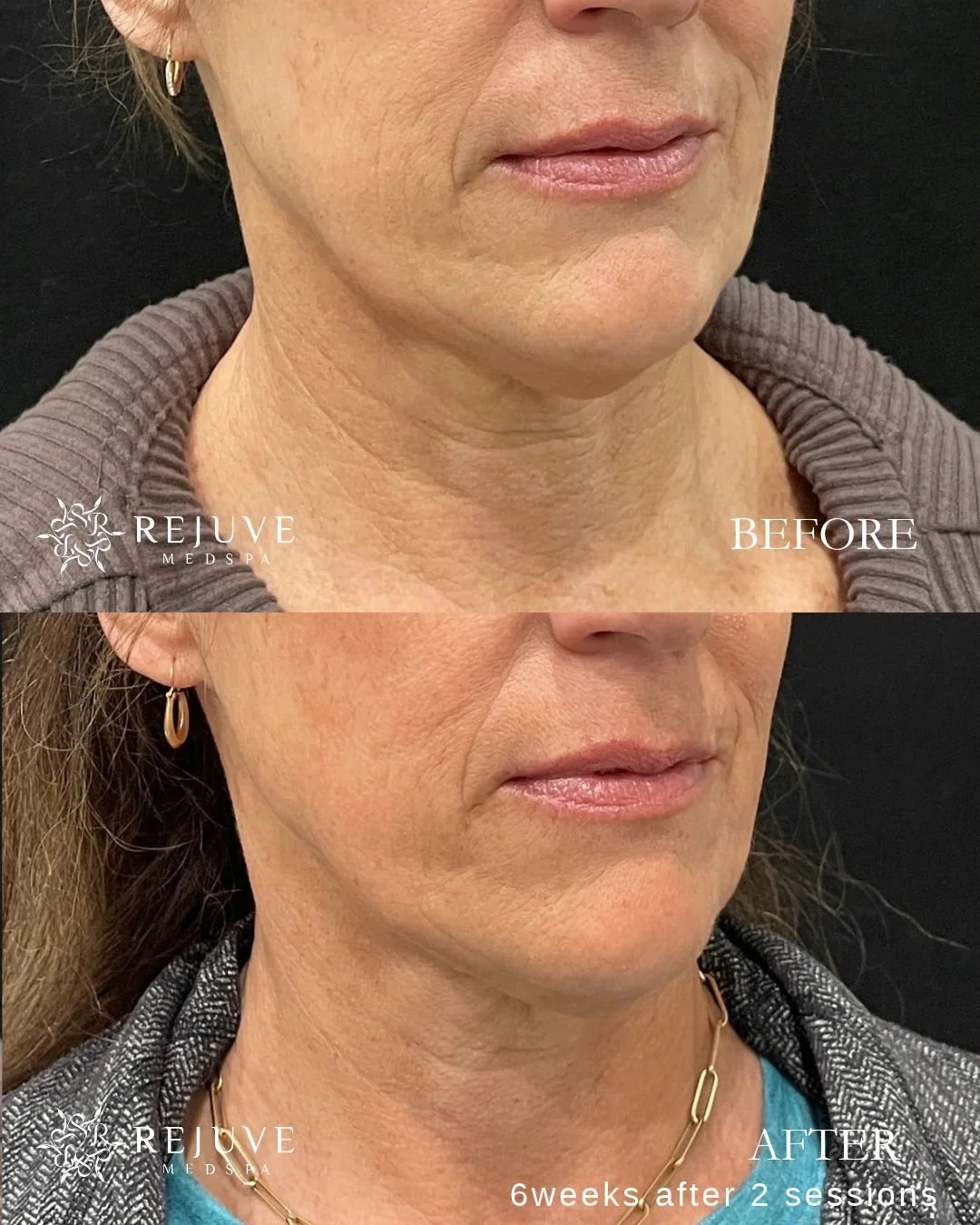 XERF before and after photo at Rejuve Medspa near Seattle and Bellevue