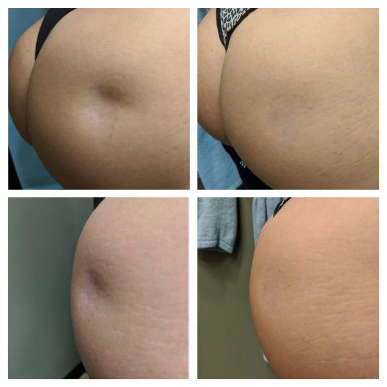 Renuva | Nonsurgical Fat Transfer | Seattle | Bellevue | Sammamish ...