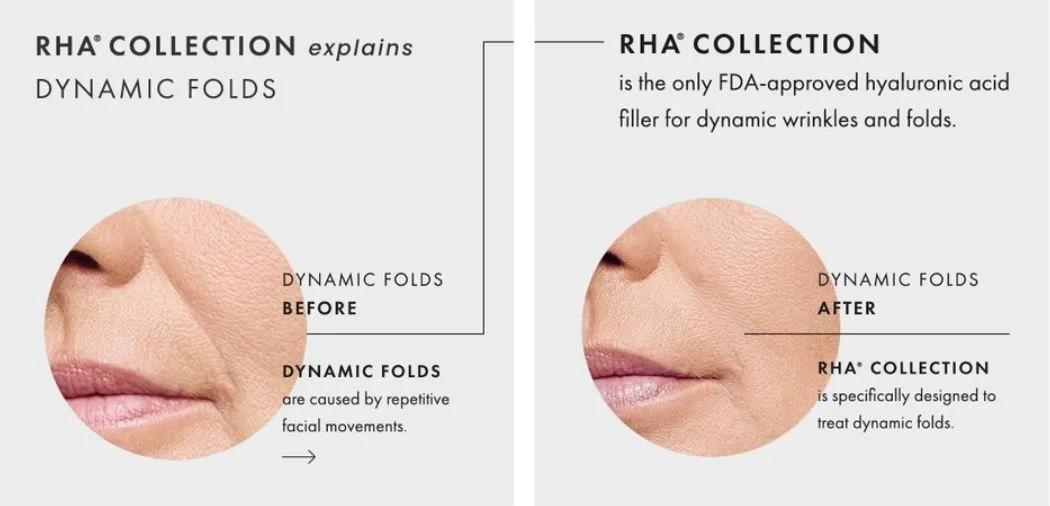 RHA Filler — Rejuve Medspa Newcastle near Seattle, Bellevue, Renton, Issaquah, Sammamish