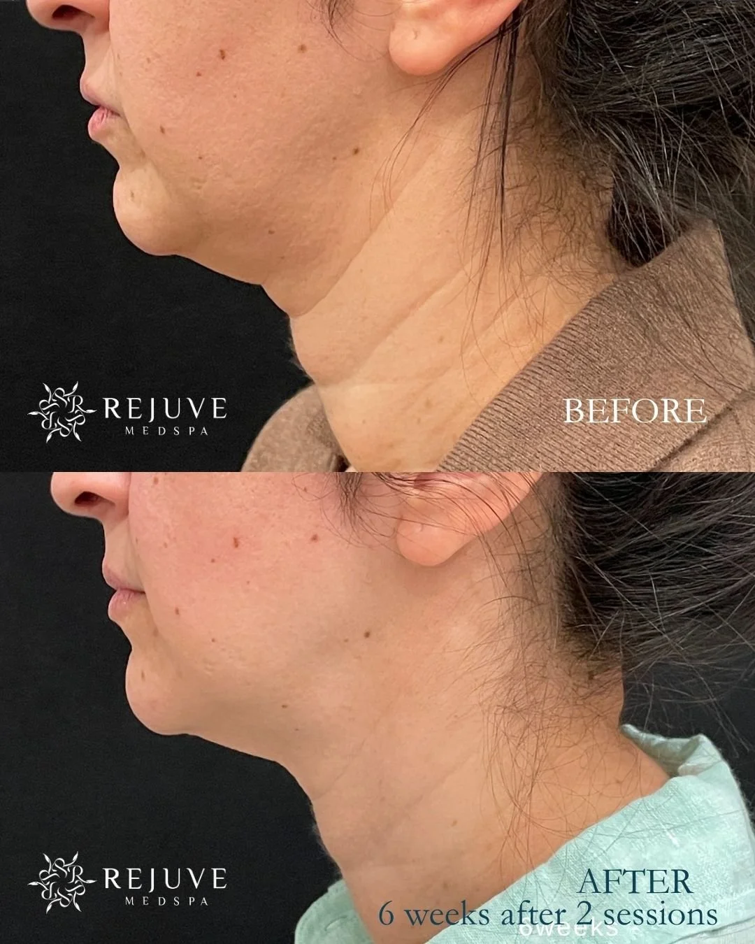 XERF at Rejuve Medspa | Newcastle near Bellevue, Seattle, Issaquah