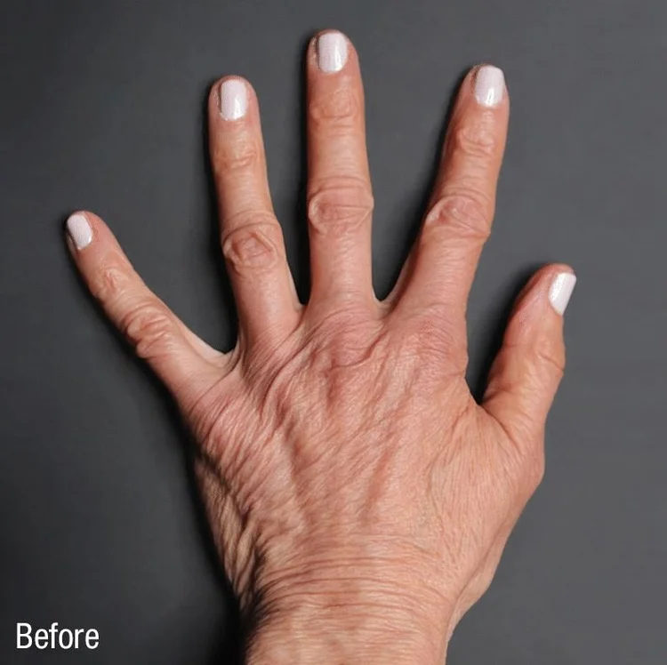 Renuva Nonsurgical Fat Transfer Seattle Bellevue Sammamish