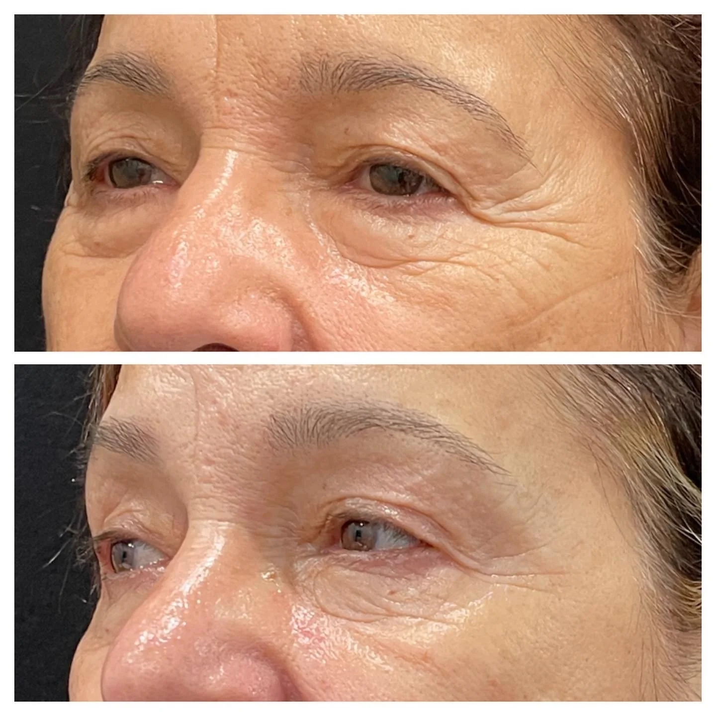 Exilis Ultra Nonsurgical Eye Lift | Rejuve Medspa