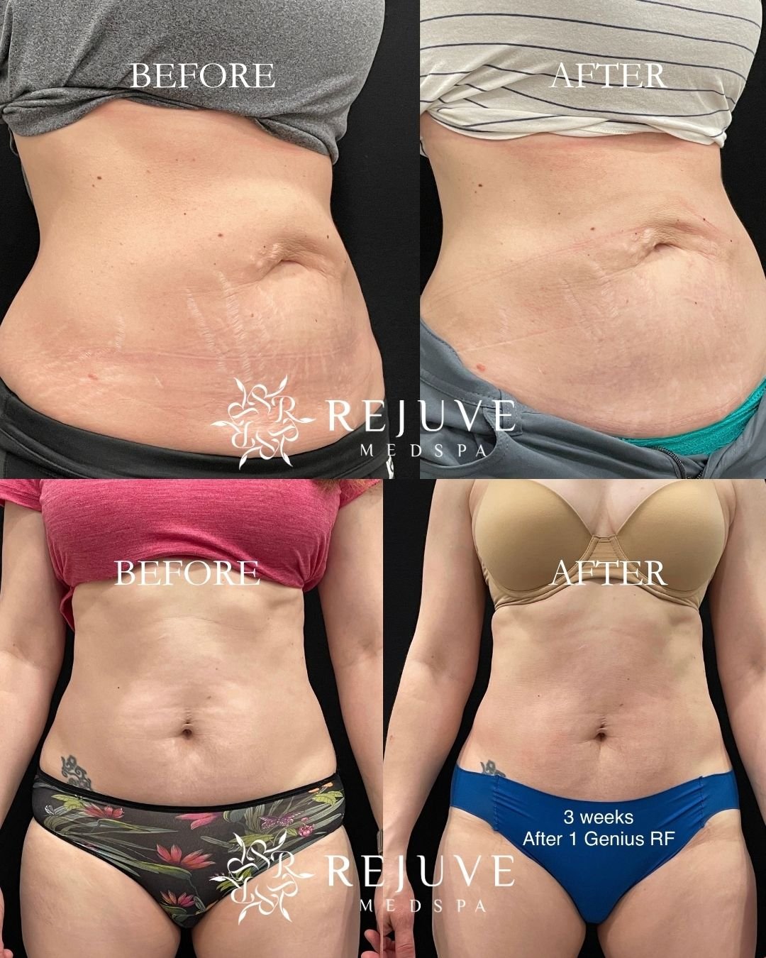 Genius RF microneedling at Rejuve Medspa in Newcastle near Seattle, Bellevue, Issaquah