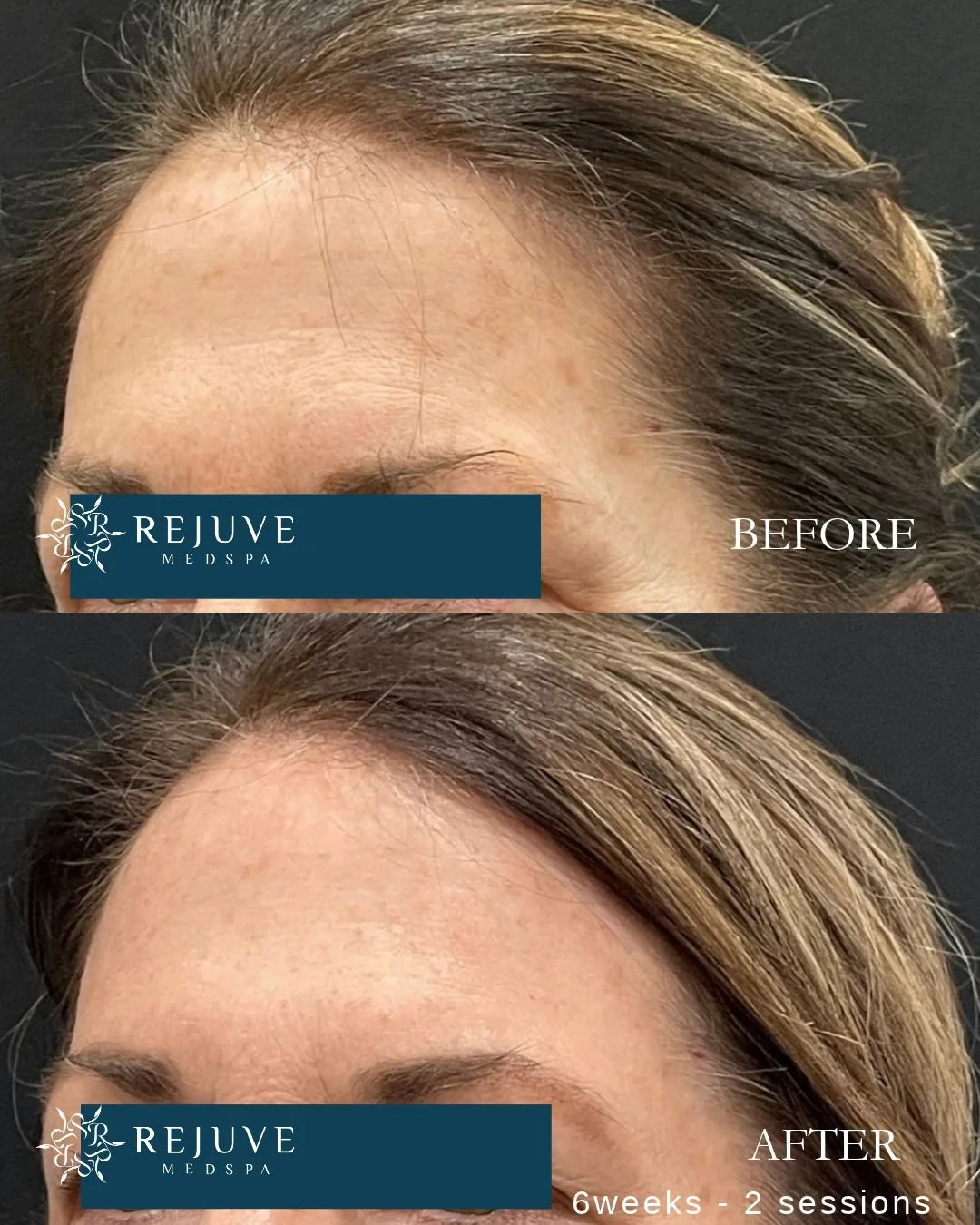 XERF before and after photo at Rejuve Medspa near Seattle and Bellevue