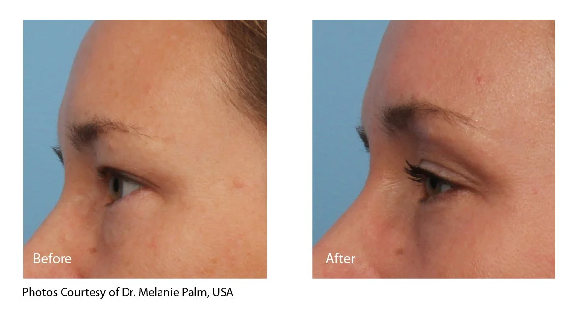 EcoTone | eCO2 Laser before and after photo