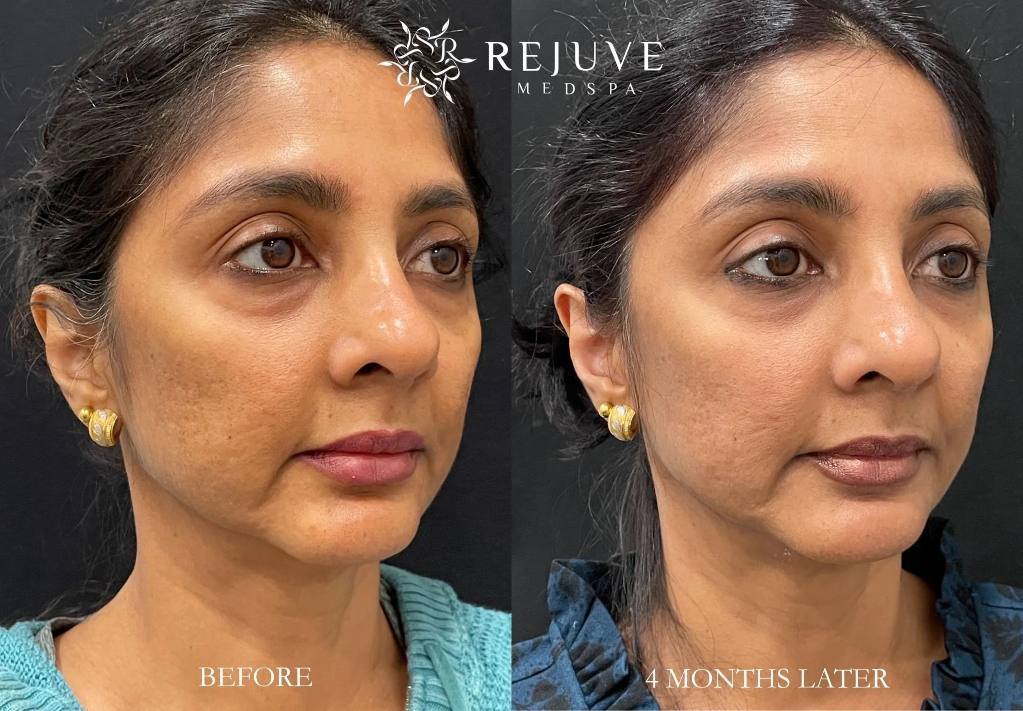 Renuva Before and After photo | Rejuve Medspa