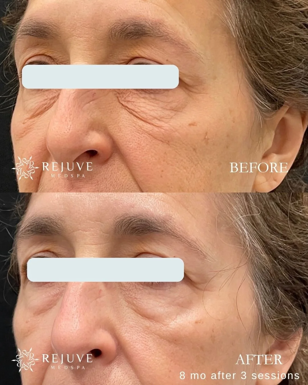 XERF at Rejuve Medspa | Newcastle near Bellevue, Seattle, Issaquah