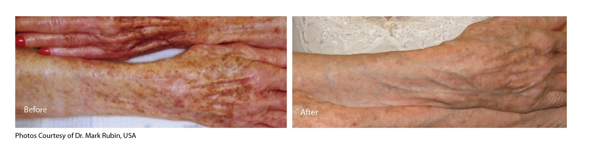 EcoTone | eCO2 Laser before and after photo