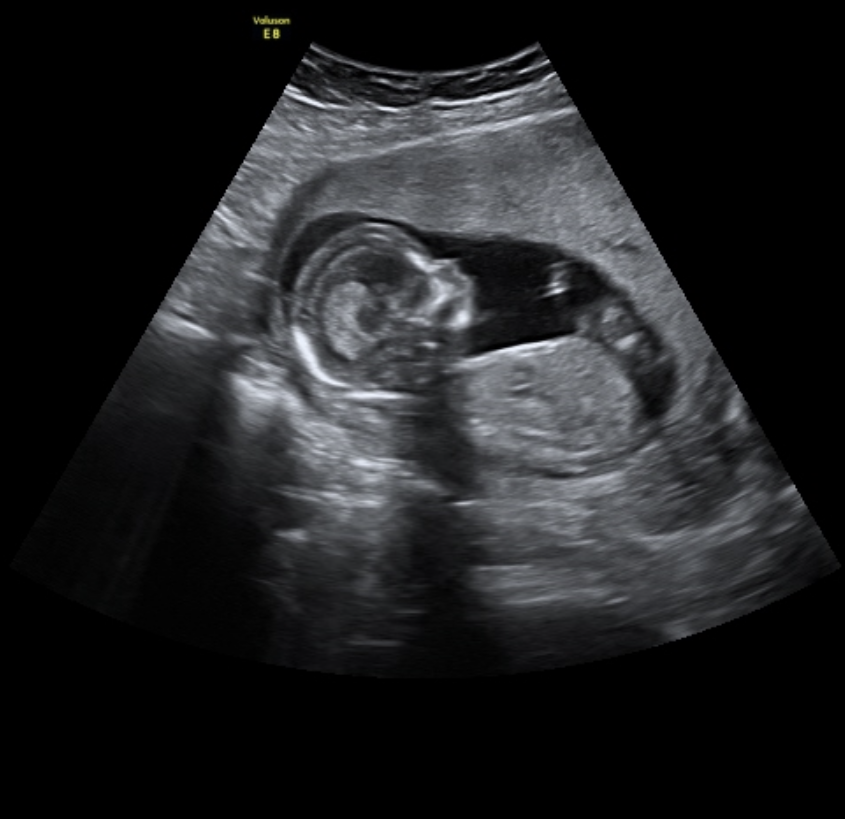 Early Gender Scans | Meet the Baby