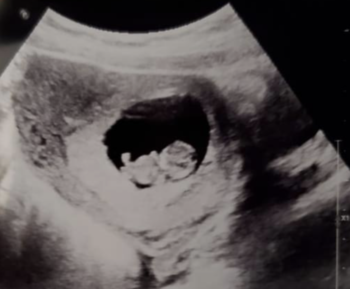 Pregnancy Scans | Baby Scans from Weeks | the
