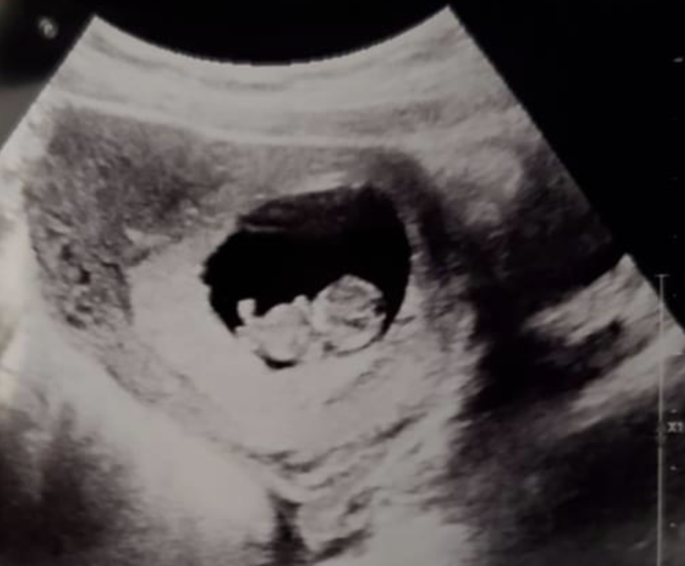 Early Pregnancy Scans | Baby Scans from 8 Weeks | Meet the Baby
