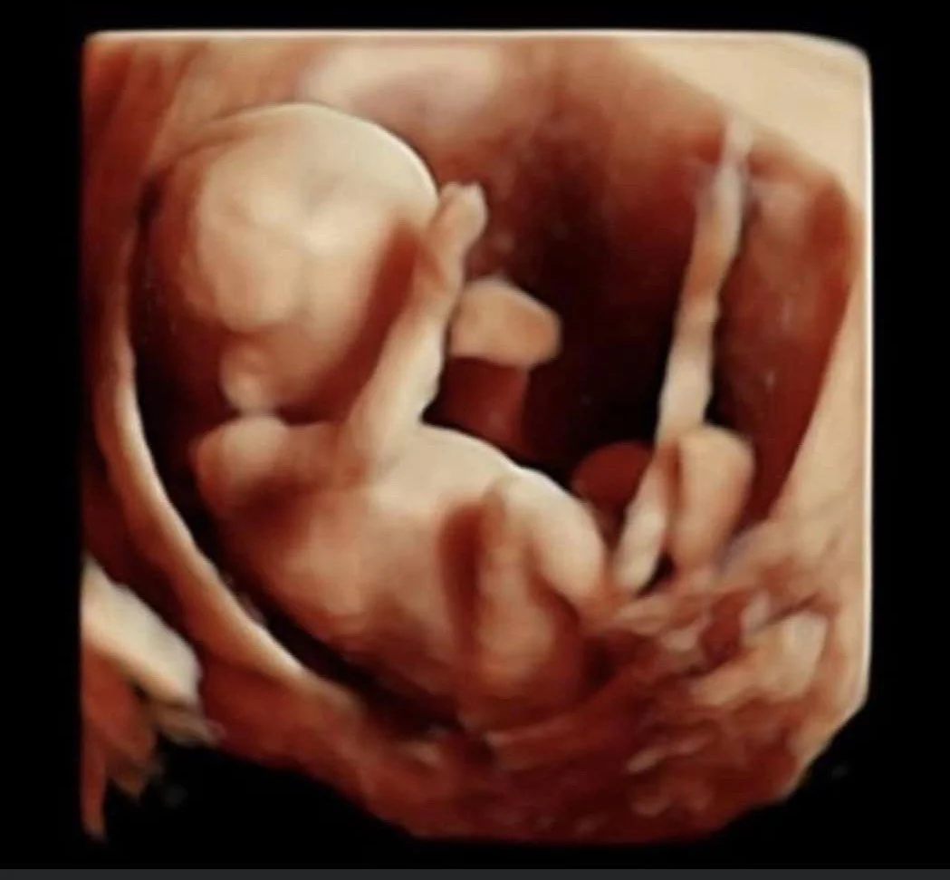 Early Gender Scans | Meet the Baby