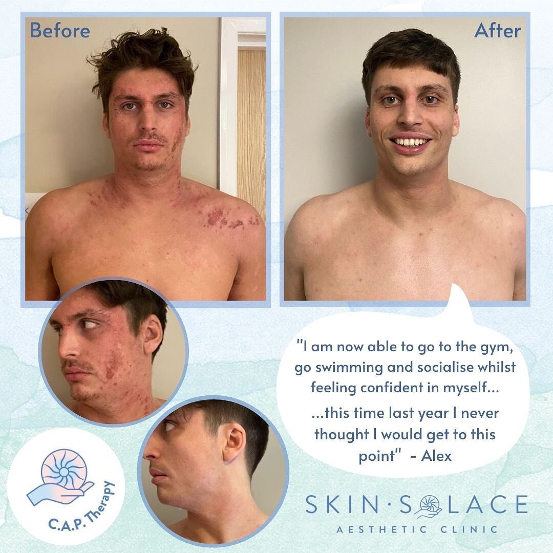 We are so happy to have supported Alex recover from (T)SW. Here is his full review on our Ultra-Pulse CAP therapy: 

&ldquo;My experiences with eczema and TSW have been a rollercoaster of a ride. I have been going through TSW for over 3 years now and