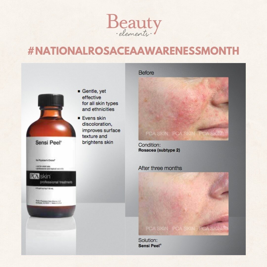 It's #NationalRosaceaAwarenessMonth! We have the perfect Chemical Peel treatment to help with Rosacea... check out these amazing results! Book online with us or call our office to secure your spot today! 
#BeautyElements #Facial #ChemicalPeel #Skinca