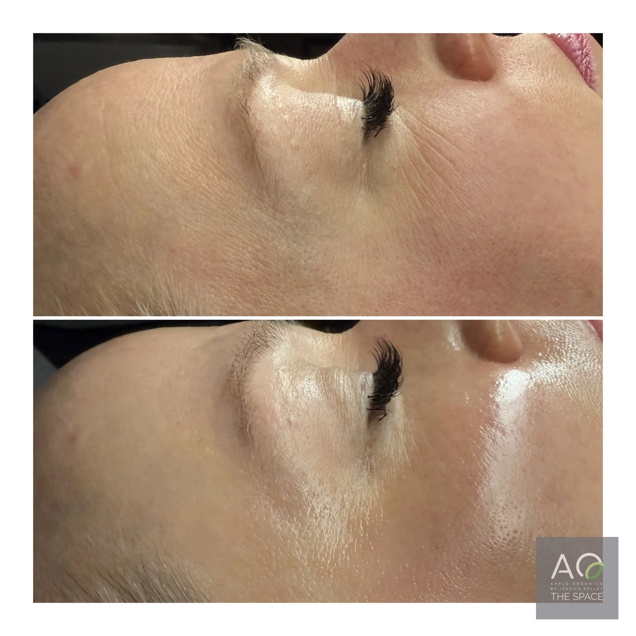 Discover the Power of Zemits VerstandHD: The Most Advanced Facials in Greenville, SC. Now Available at AO–The Space