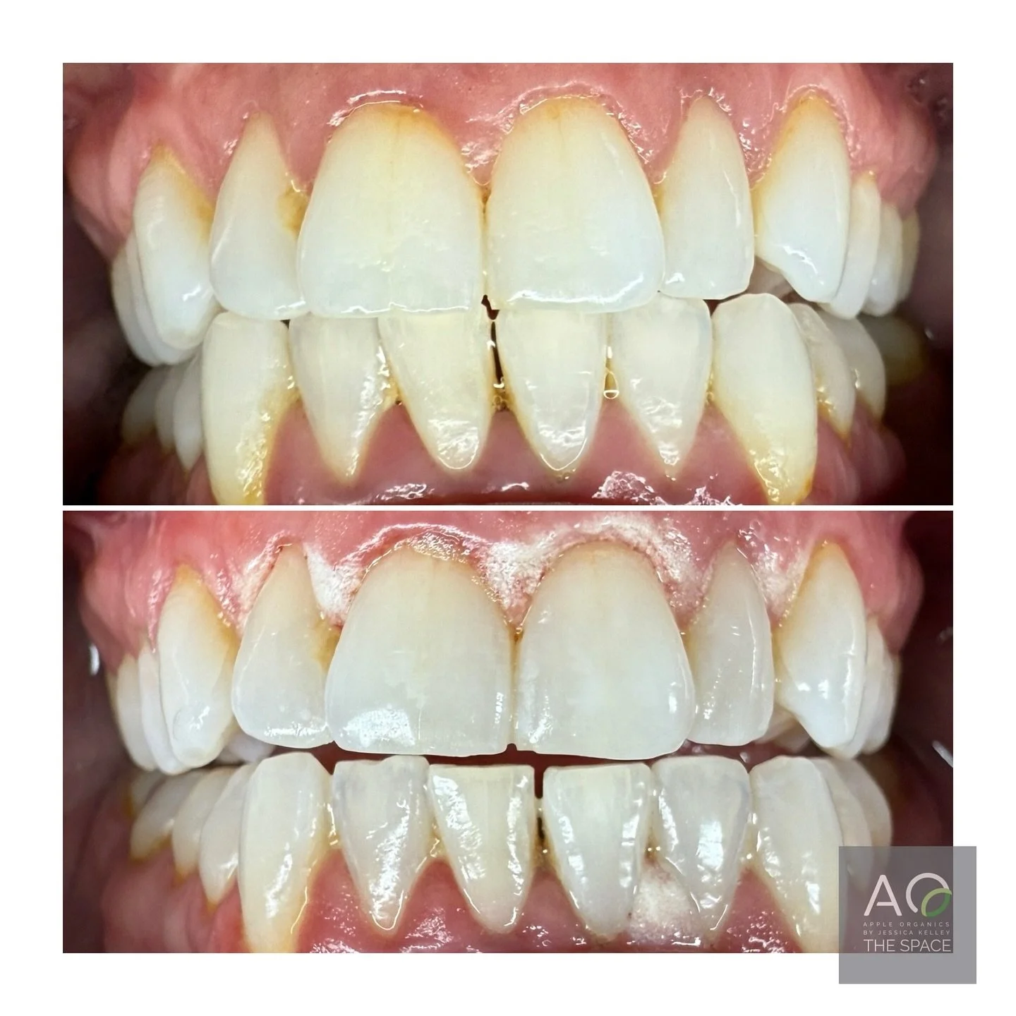 🦷✨ Five shades lighter&hellip; and simply stunning! ✨

Our client&rsquo;s smile transformation from yesterday still has us smiling too! We focused on lifting discoloration closest to the gum line - eliminating that subtle ombr&eacute; effect for an 